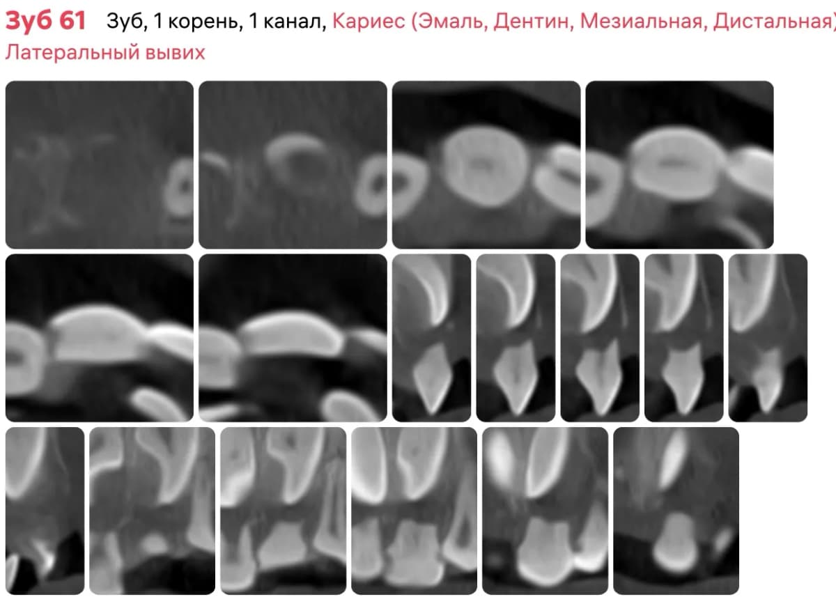 Срез 6.1 зуба до начала лечения