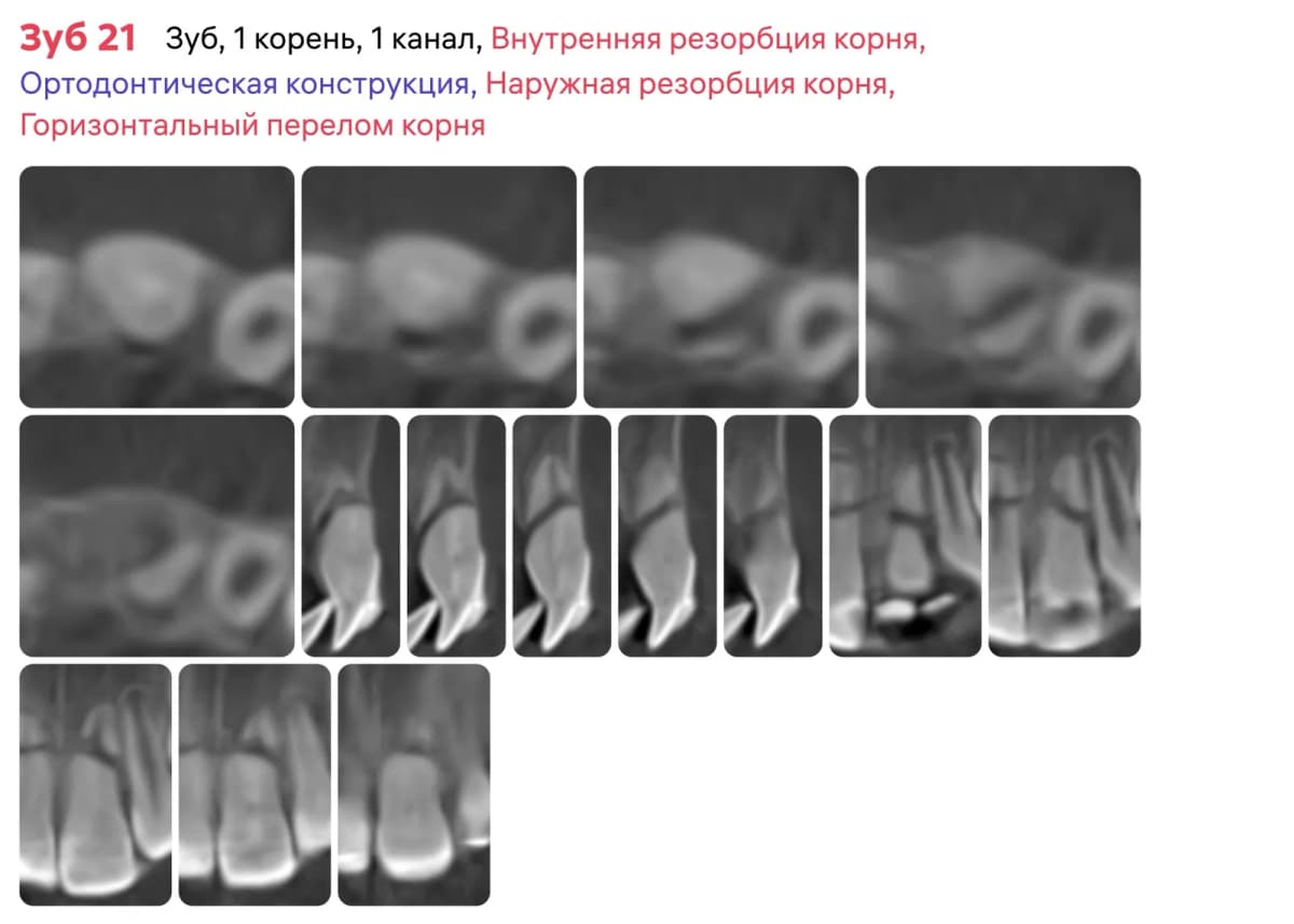 Срезы 2 1 зуба первого приема после оказания первой помощи и начала