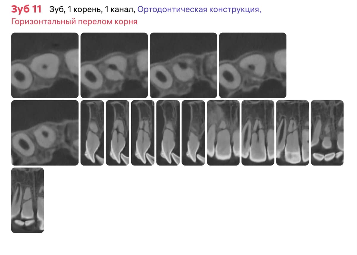 Срезы 1 1 зуба на контрольном визите через 4 месяца, снятие шины