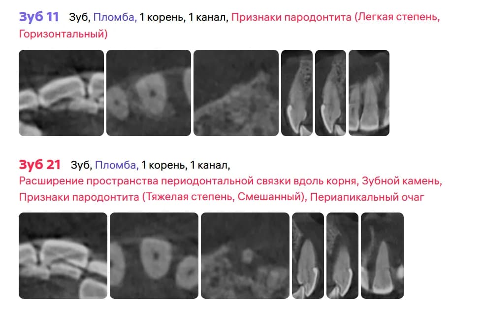 Состояние зуба 2.1