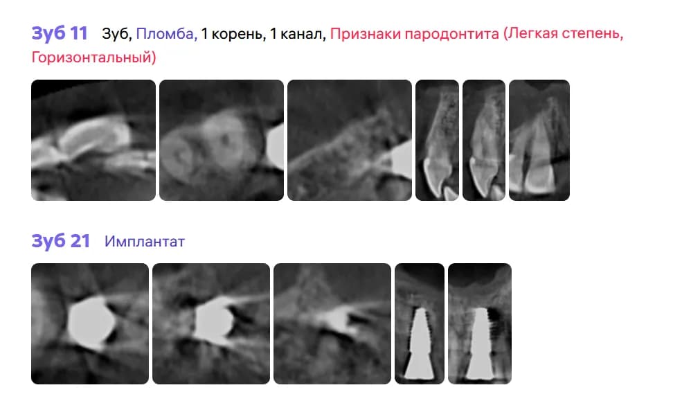 Установленный имплантат в области 2.1