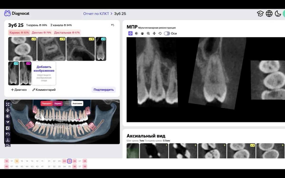 Исходные срезы зуба 2.5 в Diagnocat