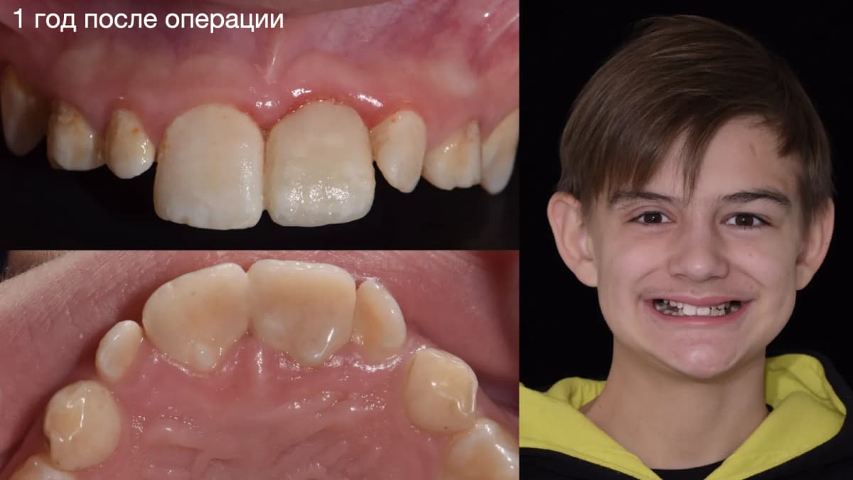 Рекол через 1 год