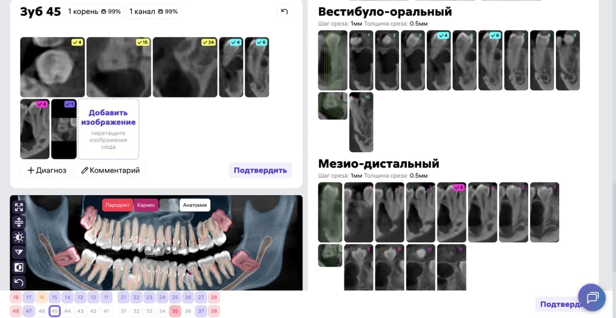 Срезы Diagnocat в области зуба 4.5 ПОСЛЕ лечени