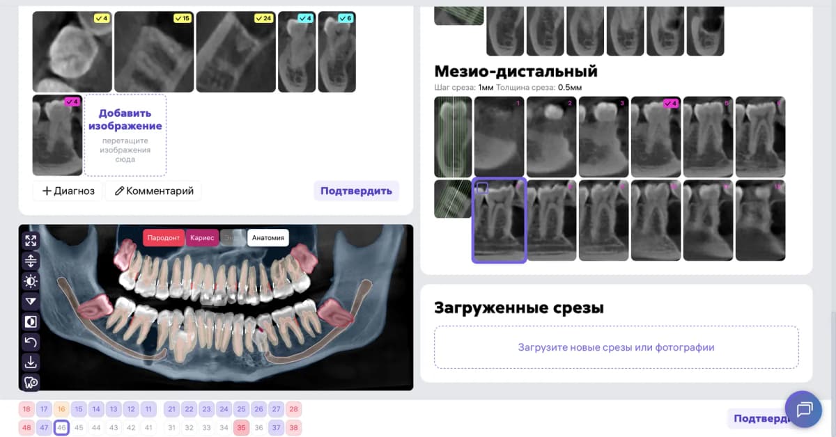 Срезы Diagnocat в области зуба 4.6 ПОСЛЕ лечения