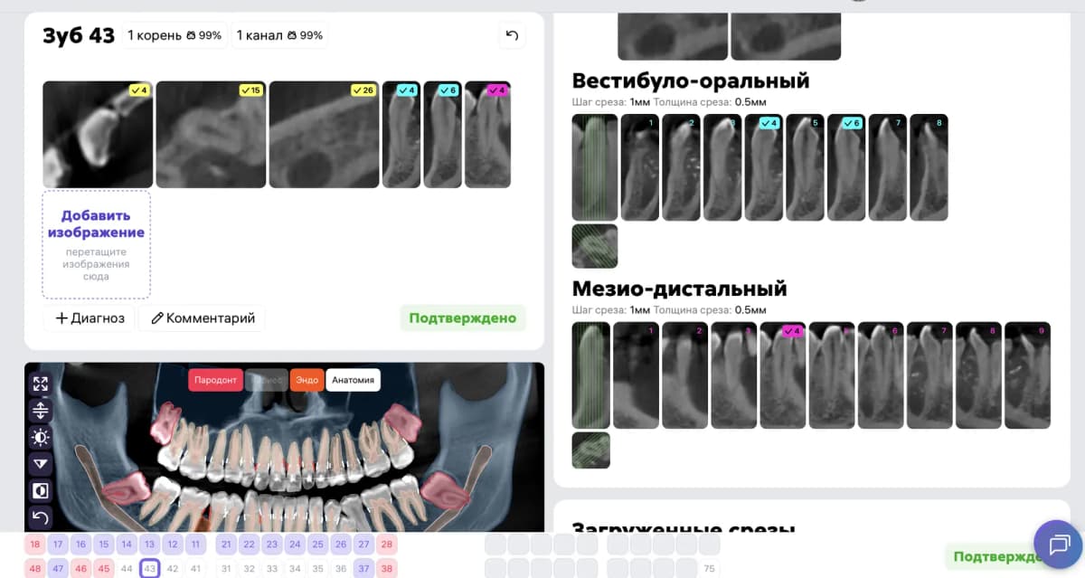 Срезы Diagnocat в области зуба 4.3 ПОСЛЕ лечения