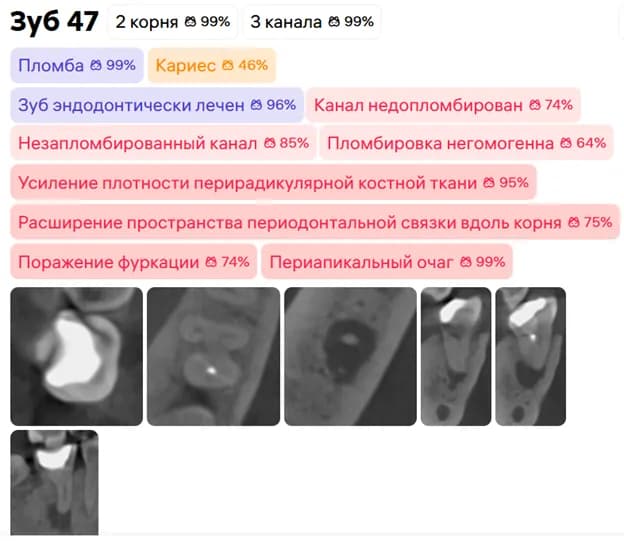 Данные отчета Diagnocat зуба 4.7