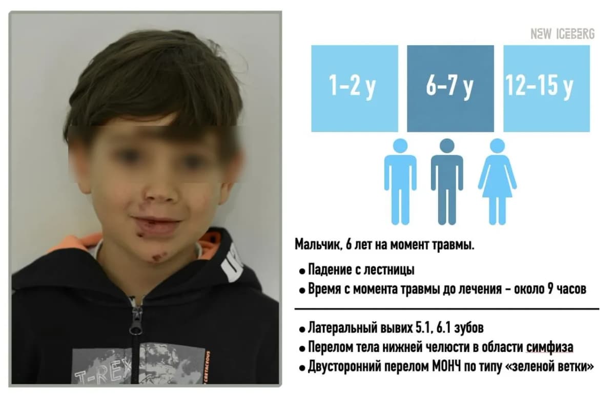 Лечение множественных переломов нижней челюсти у ребёнка 6 лет