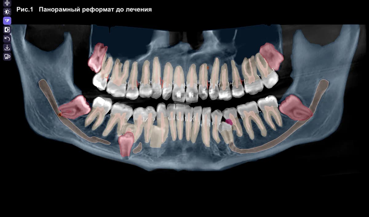 Удаление сверхкомплектных зубов с 3D-планированием в Diagnocat